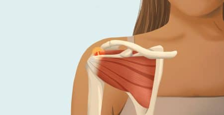 Leziunile coafei rotatorilor