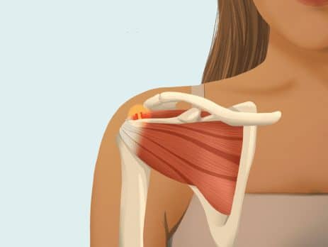 Leziunile coafei rotatorilor