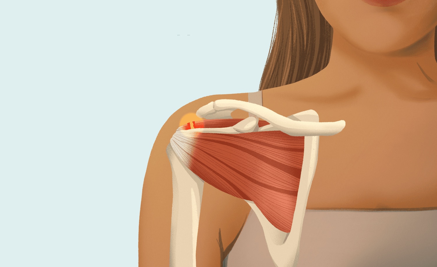 Leziunile coafei rotatorilor